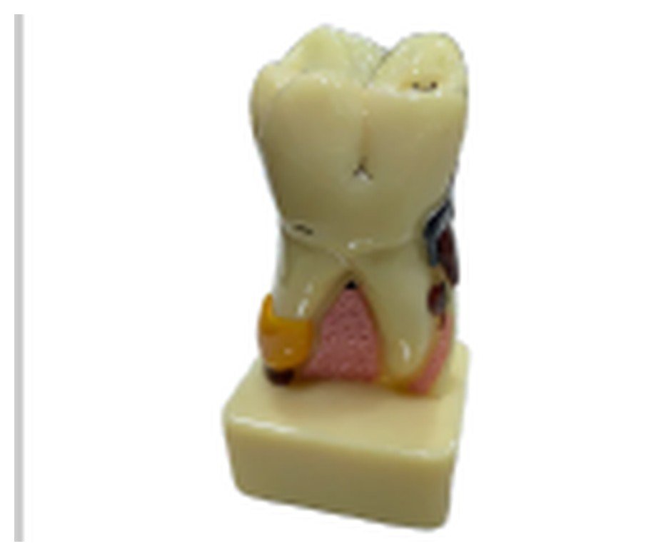 Modelo de Dente Molar Ampliado - Saudável e com Cárie